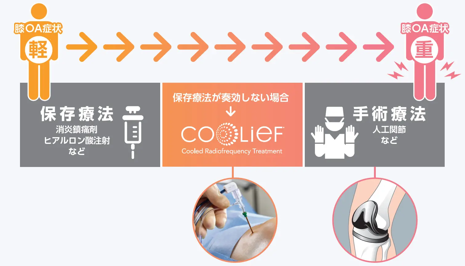 Coolief 疼痛管理用高周波システムの治療対象